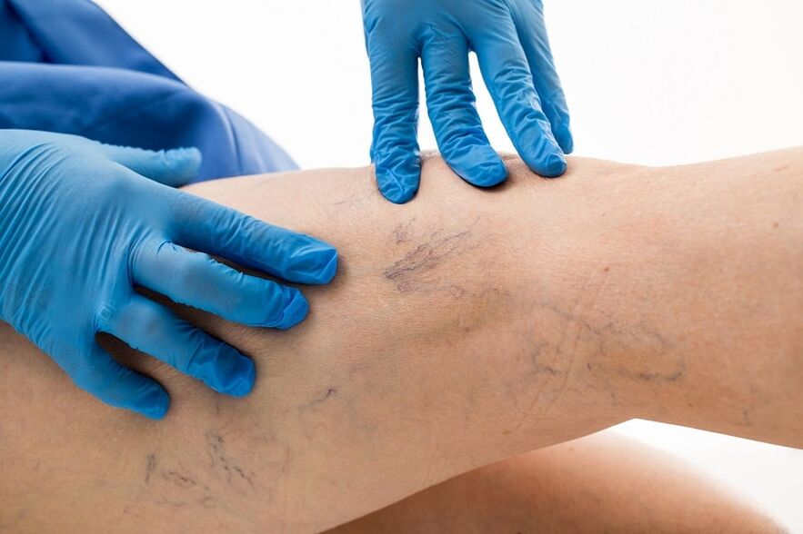 Varices na perna