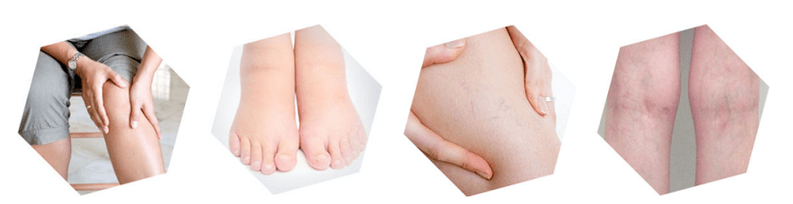 Varices