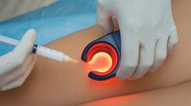 Terapia de venclerose para varices